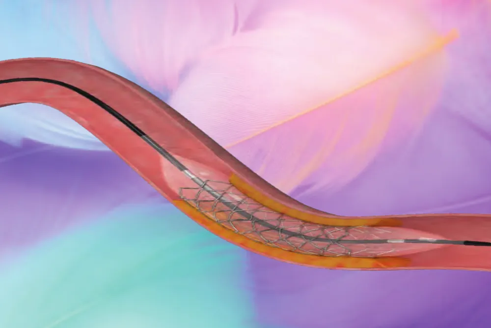 MedSure Sirolimus Stent